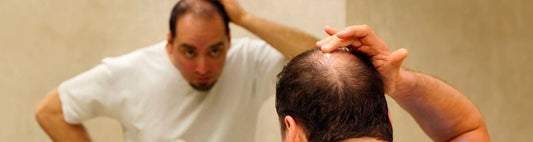 Calvitie vertex : causes, symptômes et solutions efficaces